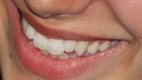 zuby smile-665433 1280